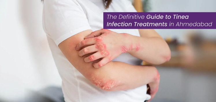 Tinea Infection Treatments in Ahmedabad
