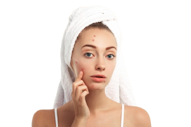Acne Treatment